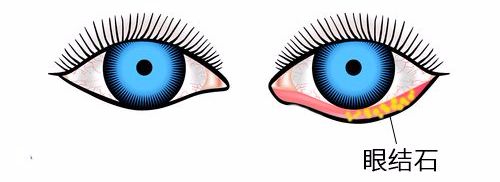 哪些结石每个人都会有,几种结石里哪一种最痛苦