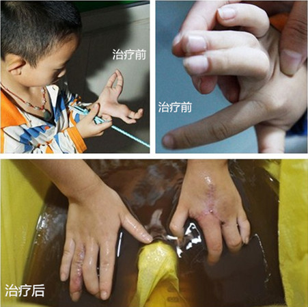 手足畸形矫正,手足畸形精准治疗