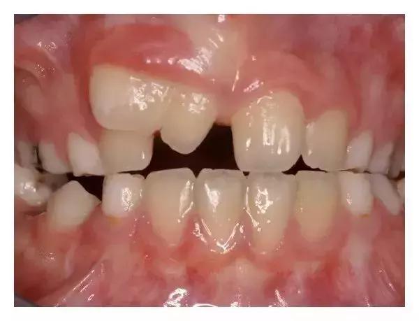 孩子两颗牙长在一起了怎么办,宝宝两颗牙长到一起怎么办