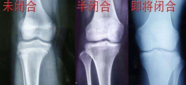 骨骺闭合真的没有可能长高了吗,骨骺闭合后怎么才能长高