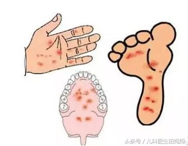 手足口病脱甲后长的新指甲一样吗,得了手足口病指甲脱壳