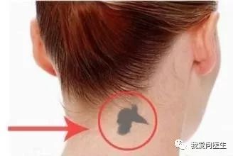 后天胎记怎么去除,8个月太田痣可以彻底祛除吗