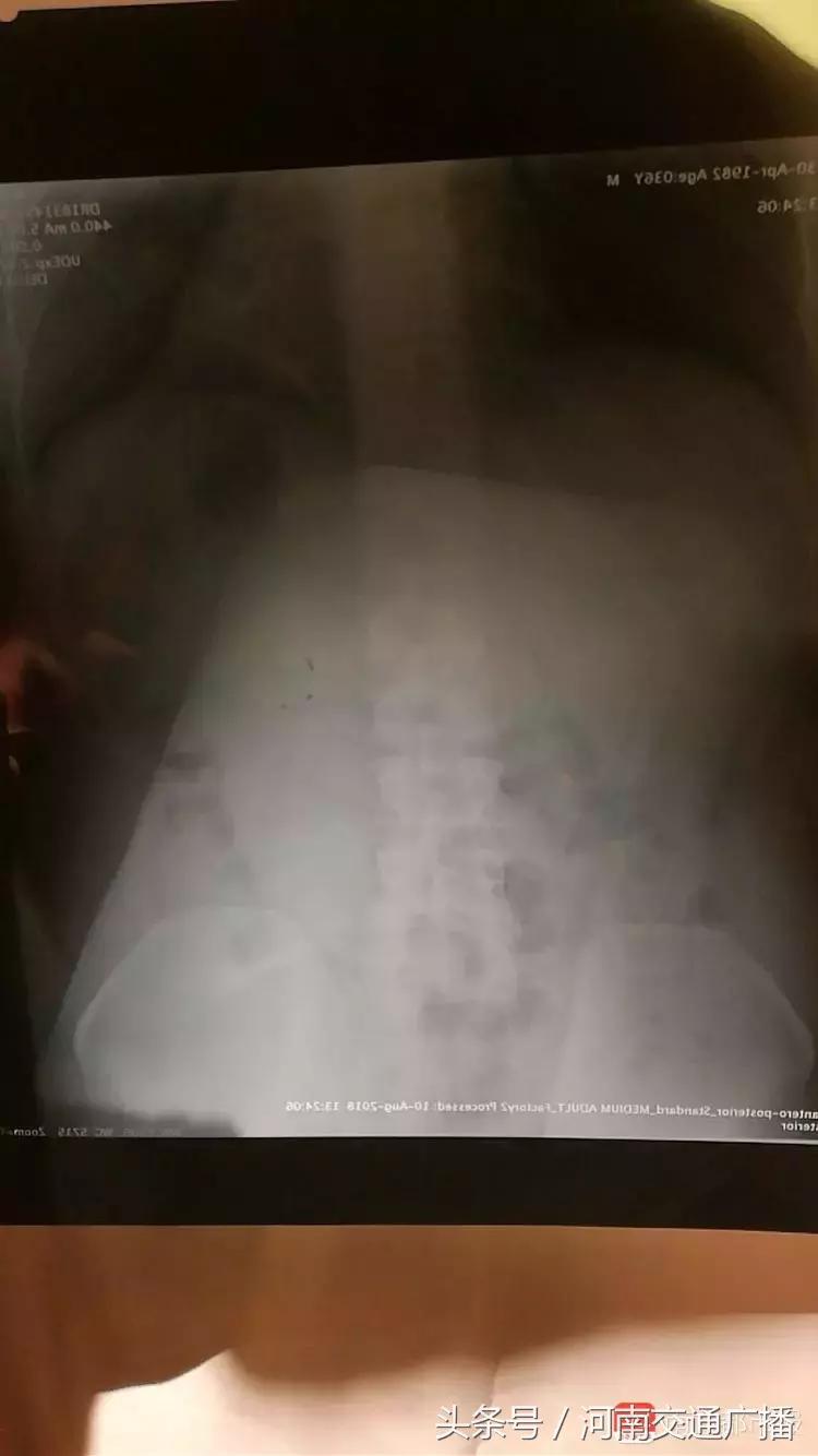 飞机餐吃出苍蝇怎么赔偿,飞机餐吃出异物怎么赔偿