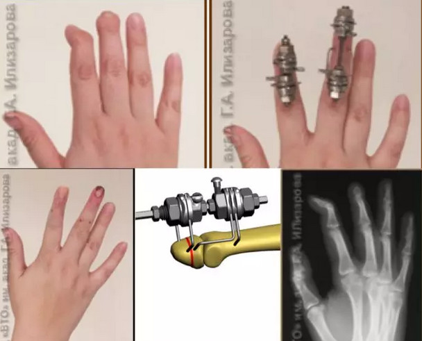 手足畸形矫正,手足畸形精准治疗