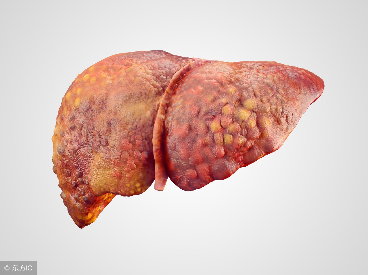 肝硬化吃保肝护肝药能防肝癌吗,肝硬化治疗稳定并发症会消失么