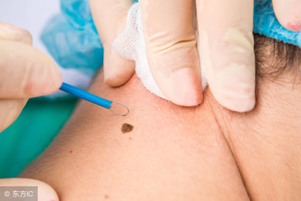 身上黑色素痣越来越多是怎么回事,黑色素痣患者全身出现好多黑痣