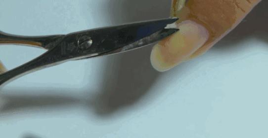 拔手指倒刺感染导致截指,为什么撕手上倒刺会导致截指