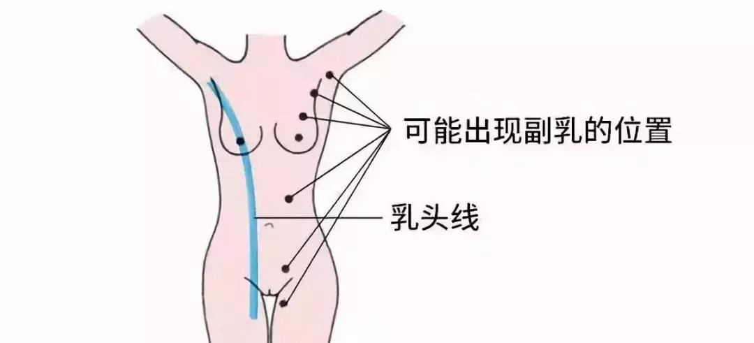 什么是副乳?副乳的危害有哪些?副乳如何选好手术时机?