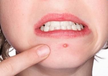 痘痘挤破了怎么快速消除痘痘,痘痘挤破了也结痂了治疗小妙招