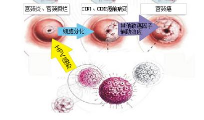 宫颈炎几年了会引起癌变,宫颈炎治疗好以后影响生育吗