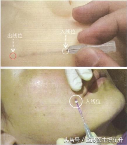 鼻唇沟松弛怎么去除,40岁脸颊凹陷面部下垂怎么解决