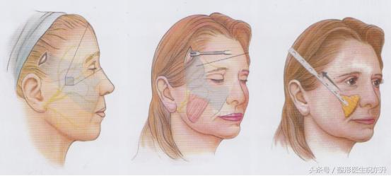 鼻唇沟松弛怎么去除,40岁脸颊凹陷面部下垂怎么解决