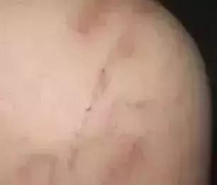 女孩脑袋上有个寄生虫,25岁女孩身体发现寄生虫