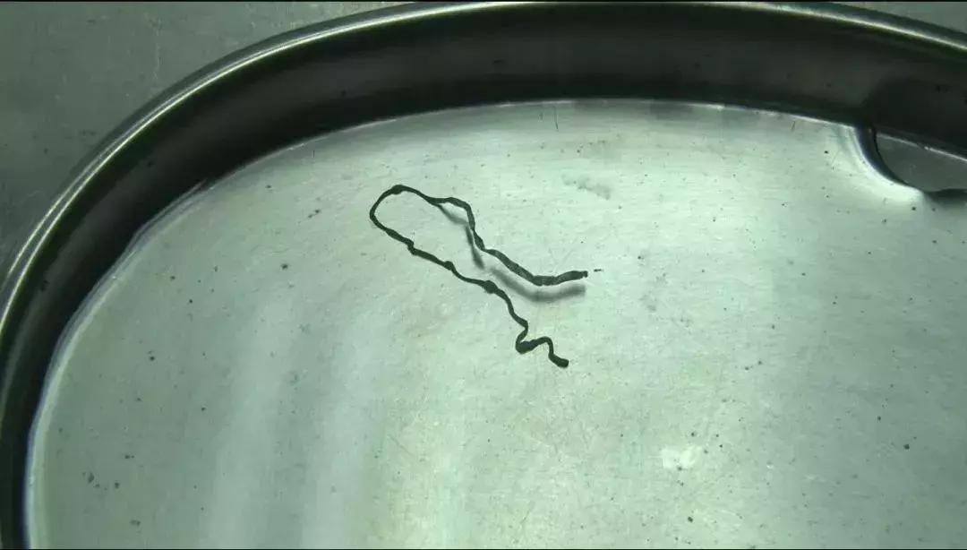 女孩脑袋上有个寄生虫,25岁女孩身体发现寄生虫