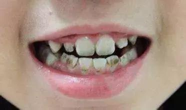 牙齿上的黑点污垢怎么能够清理掉,孩子牙齿上有黑色的斑怎么去除