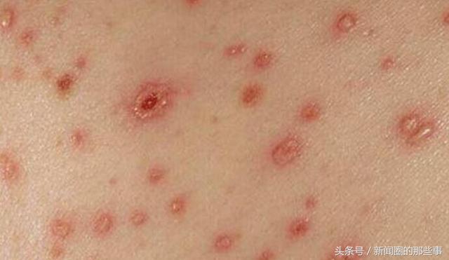 查出得艾滋的男大学生,23岁小伙查出艾滋病家人抛弃后续