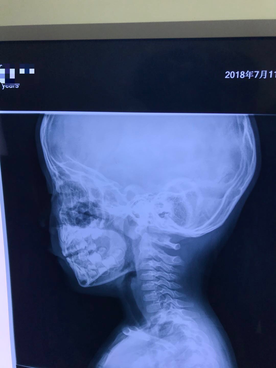 刘鉴医案:刘医生,我女儿的腺样体好了