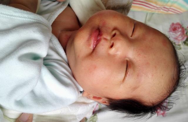 宝宝艾叶治湿疹最快的偏方,婴儿湿疹克星草