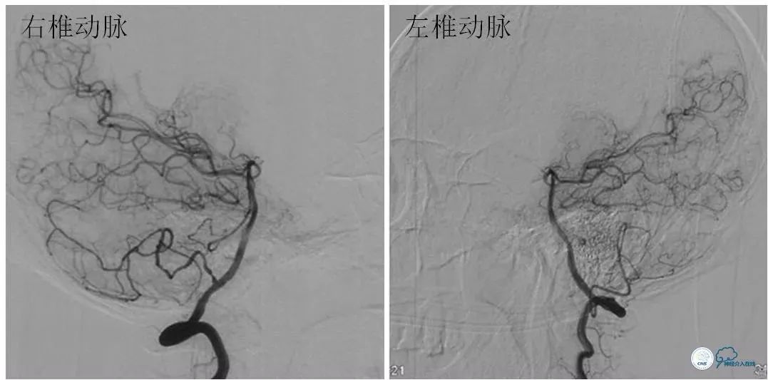 天坛医院住院日记,颈内动脉c5到c7段狭窄微创手术