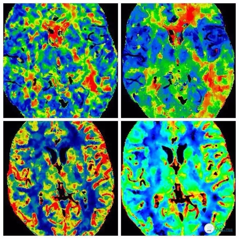天坛医院住院日记,颈内动脉c5到c7段狭窄微创手术