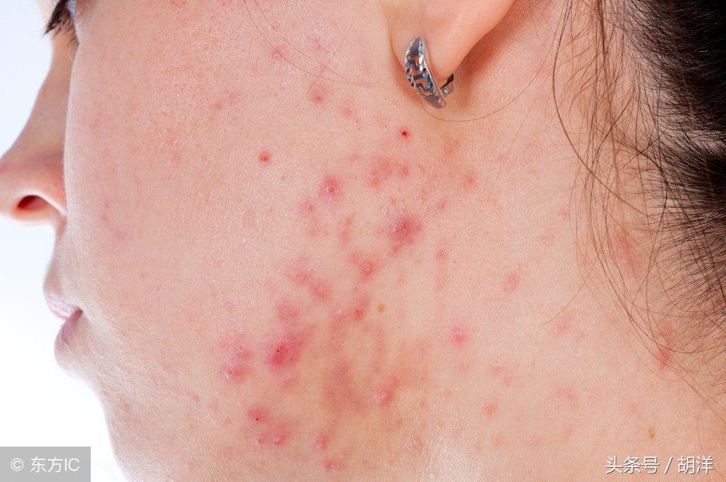 甲硝唑抗厌氧菌治疗疗效好，价格便宜用途广泛，还可以治疗*疮痤**