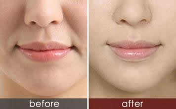 有法令纹很显老怎么办,法令纹木偶纹哪个显老