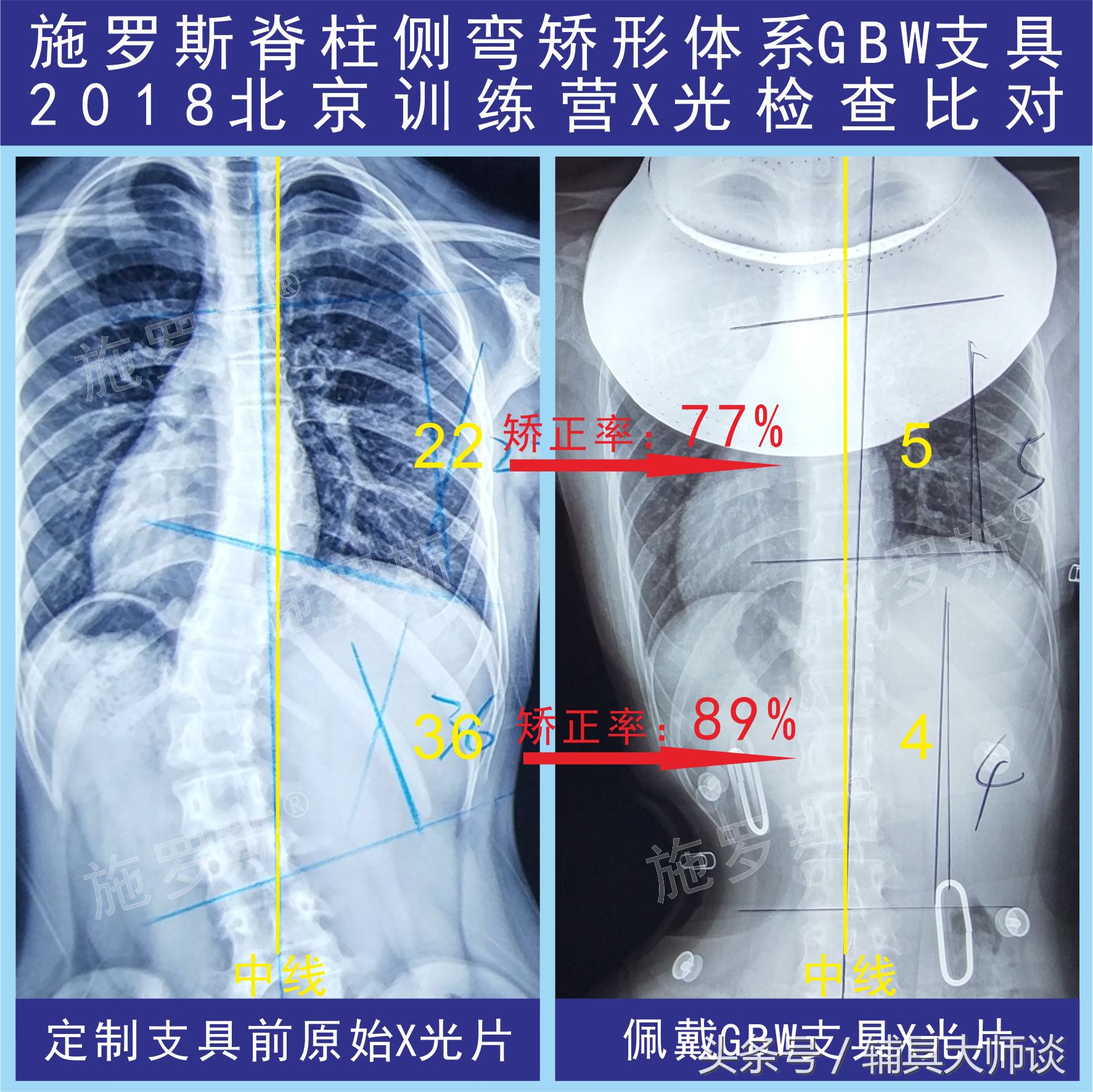 德国gbw支具侧弯60度适合吗,德国gbw支具北京哪里可以订