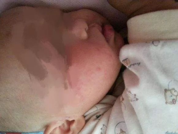 炎炎夏日，宝宝湿疹反复不好，这可怎么办？