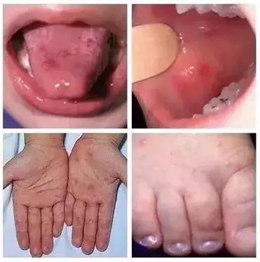 多大的宝宝容易得手足口病,宝宝几个月会得手足口病