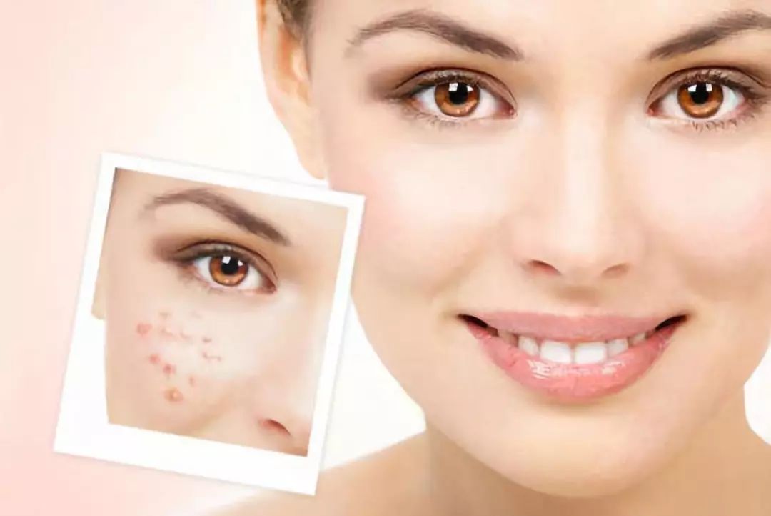 青春痘伤疤怎么修复,青春痘时间长疤痕修复的最佳方法