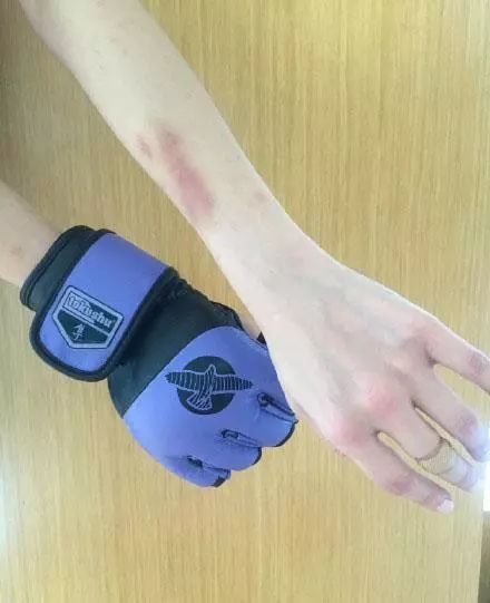 身上容易出现淤青是什么体质,身上莫名其妙出现淤青民间说法