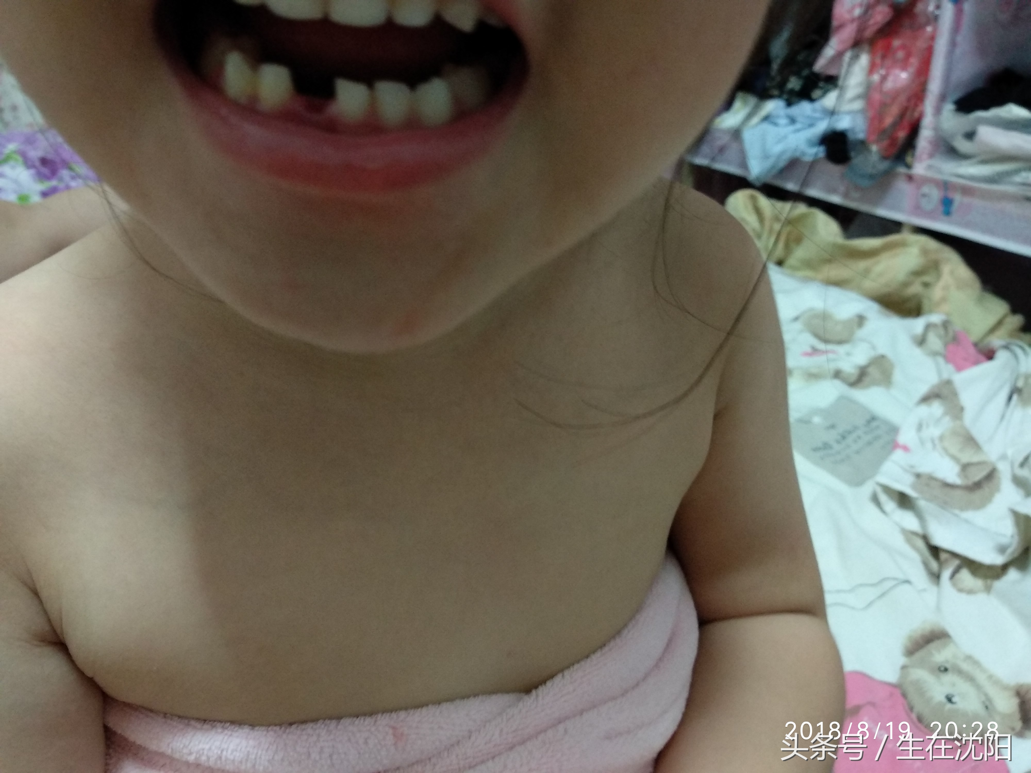 如果上牙掉了下牙会往上长吗,最后一颗上牙掉了下牙往上长