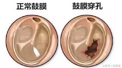 外力致鼓膜穿孔最佳治疗方法,外力击打耳朵鼓膜穿孔用什么药