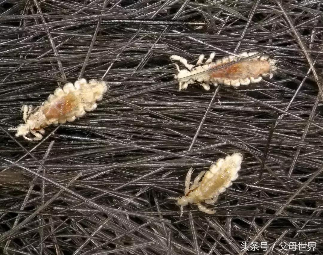 天天给女儿洗头，竟然还长了满头虱子！原因你也忽略过……