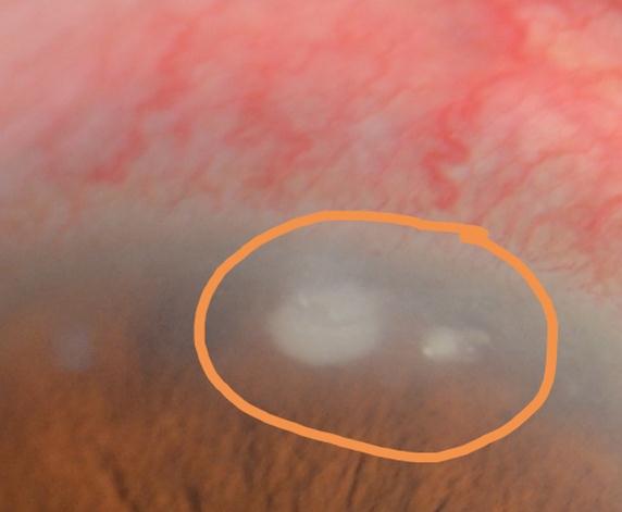 因为一只小飞虫，大妈眼角膜溃疡了……