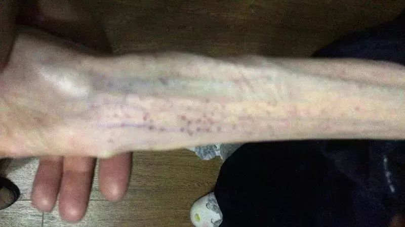 1米67才50斤!21岁女孩自杀式减肥,脑组织如60岁,沉睡40天后竟然……