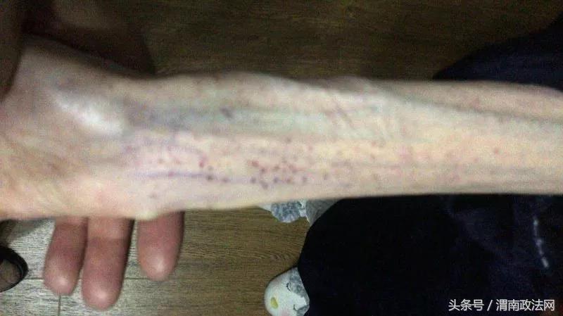 40岁女子减肥瘦10斤结果脑梗,女子减肥十天突然脑梗