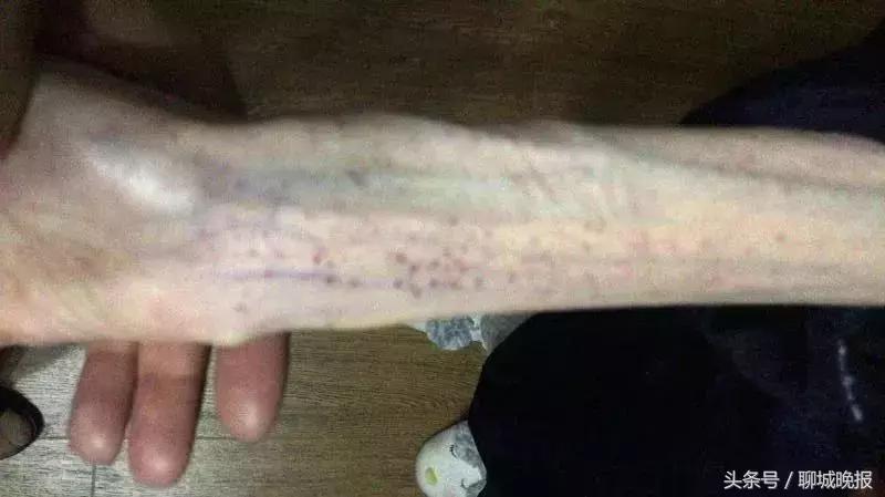 21岁女孩自杀式减肥：1米67才50斤，脑组织如60岁！照片不忍直视