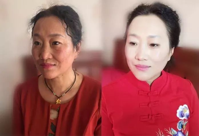 如何去除抬头纹法令纹鱼尾纹,一招改善抬头纹法令纹鱼尾纹