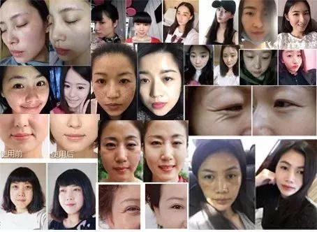 如何去除抬头纹法令纹鱼尾纹,一招改善抬头纹法令纹鱼尾纹