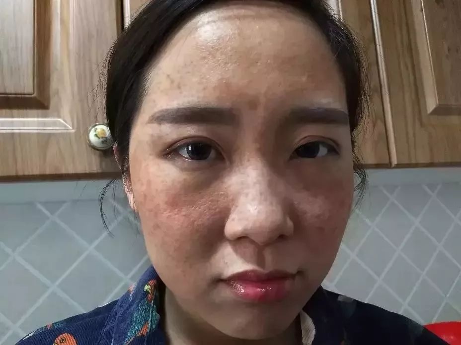 如何去除抬头纹法令纹鱼尾纹,一招改善抬头纹法令纹鱼尾纹