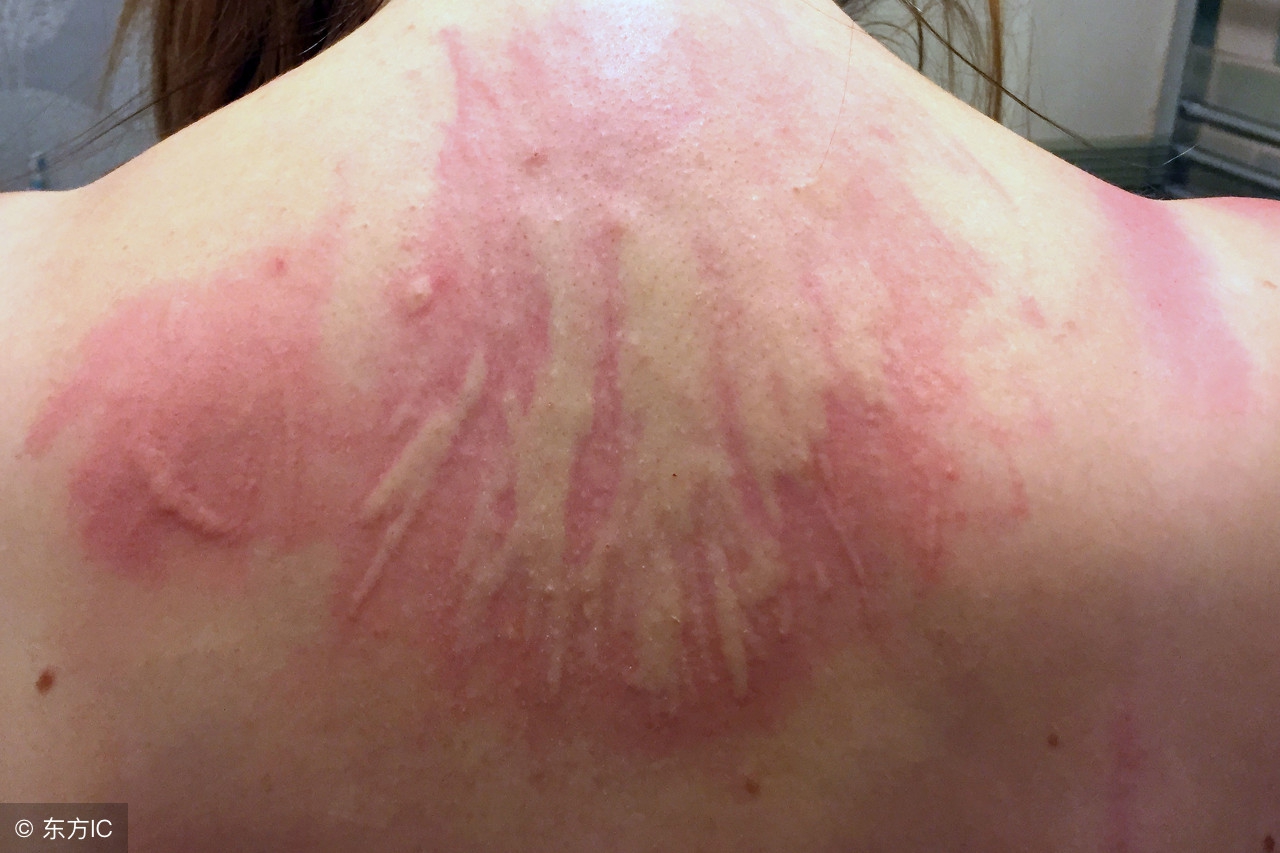 荨麻疹身上痒有哪些食物不能吃,荨麻疹吃各种药都没用怎么办