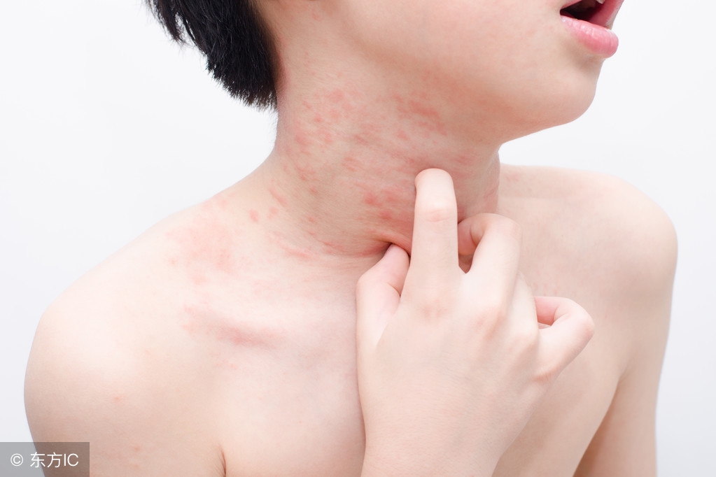 荨麻疹身上痒有哪些食物不能吃,荨麻疹吃各种药都没用怎么办