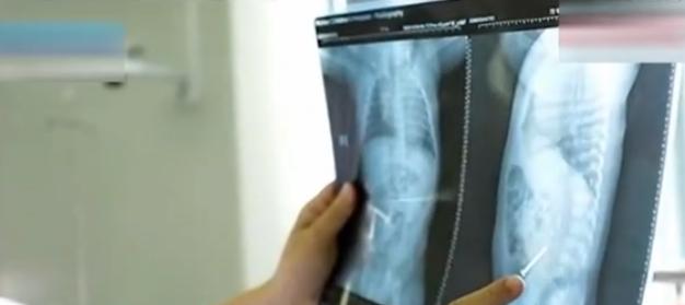 婴儿吞下一颗螺丝钉,一岁半宝宝误吞螺丝钉造成死亡