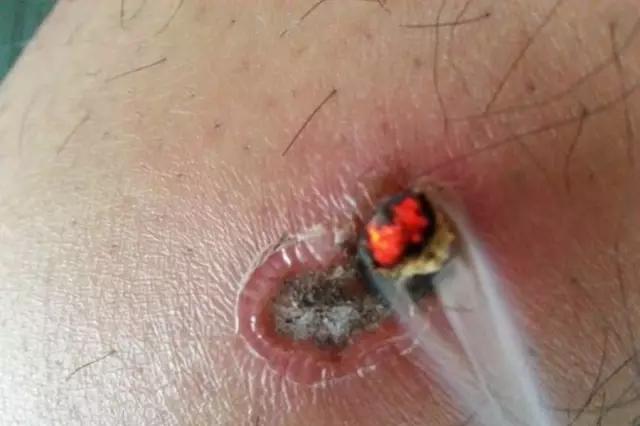 熨灸和艾灸有什么区别,中医熨灸是什么意思