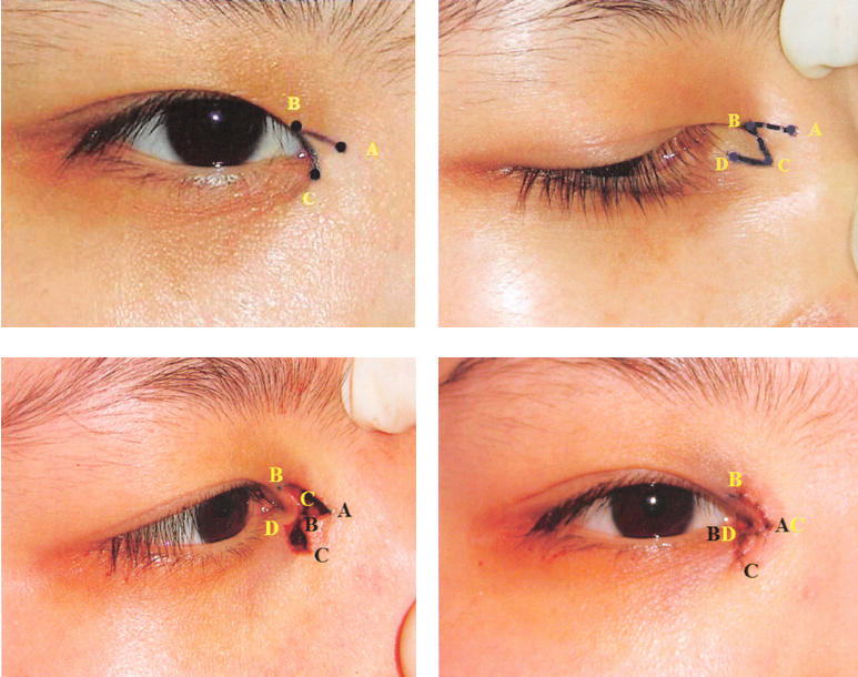 内眦赘皮要去整形医院吗,内眦赘皮怎么整形