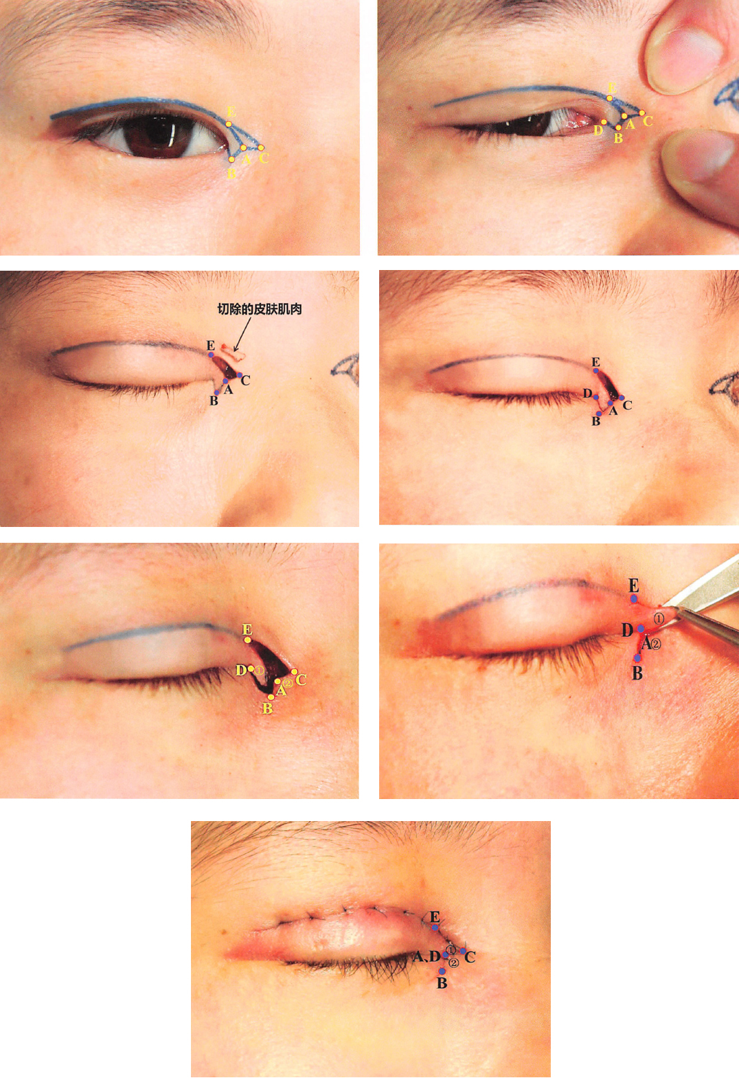 内眦赘皮要去整形医院吗,内眦赘皮怎么整形