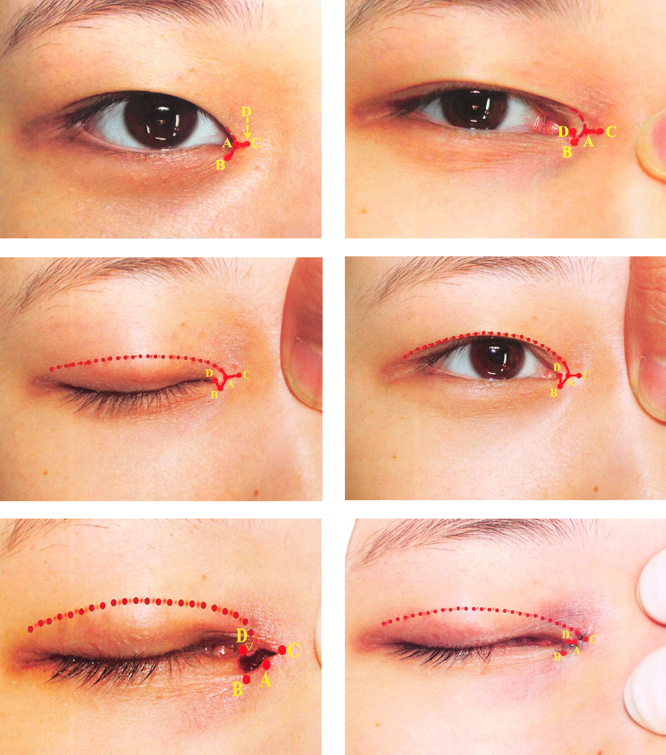 内眦赘皮要去整形医院吗,内眦赘皮怎么整形