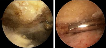 得了肩峰撞击症如何康复,肩峰撞击症是怎么回事