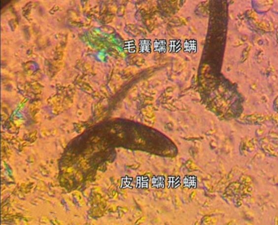 背上螨虫痘去除过程,后背长螨虫痘痘咋回事